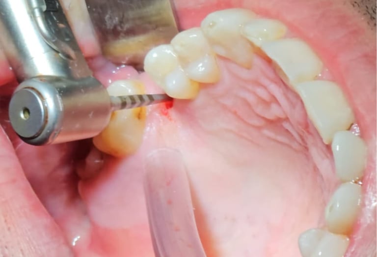 Implantología dental en Badajoz