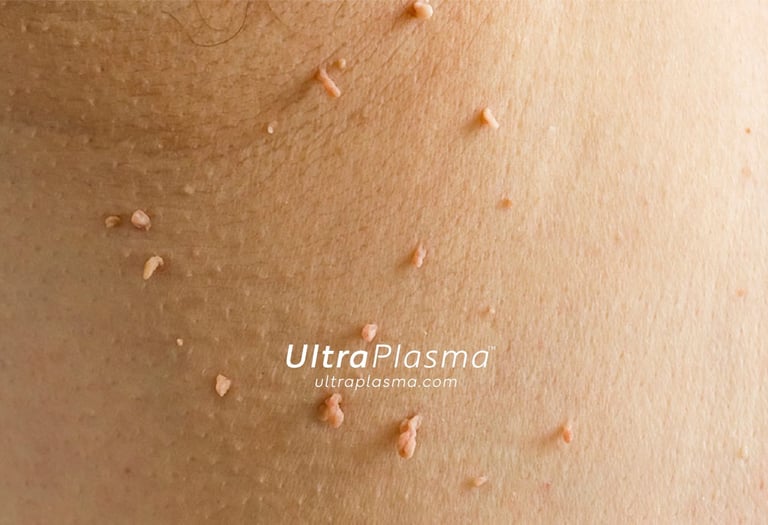 ultraplasma.com_skin_tag_removal_treatment_et_beni_temizleme_silme_tedavi_ultra_plasma_ultra_plazma2