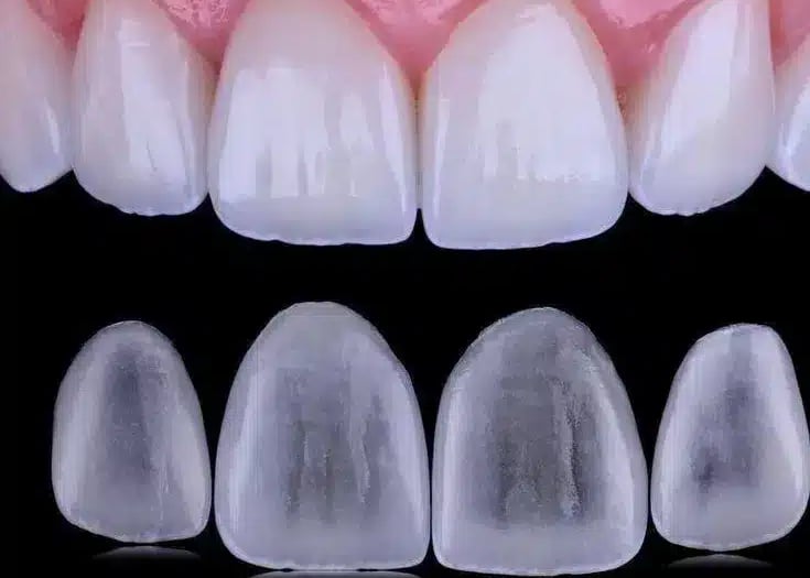 Facetas de porcelana em Curitiba para um sorriso branco e harmonioso.