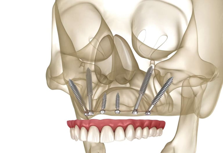 implantes cigomaticos
