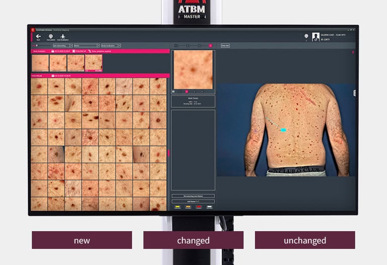 dermatoscopie computerizata Fotofinder