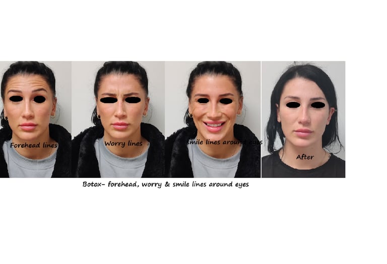 Before & after photos botox upper face – fresher, more appealing and more alert appearance.