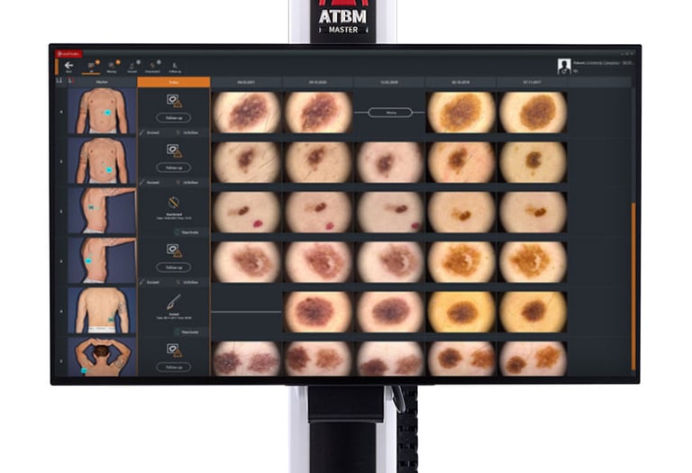 monitorizare alunite videodermatosopie fotofinder