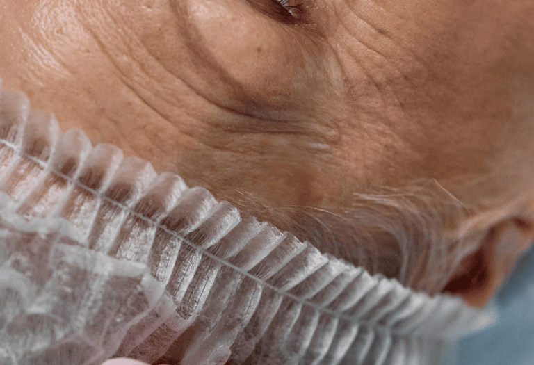 Blefaroplastia