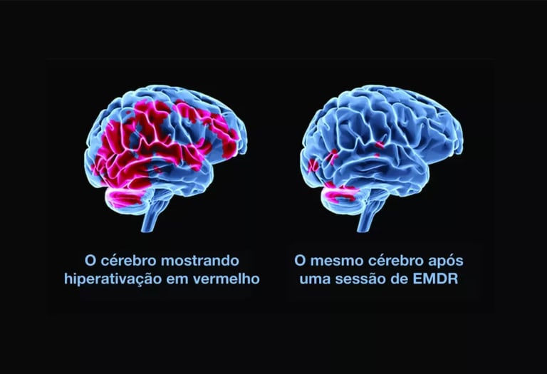  Comparação tridimensional do cérebro antes e depois de EMDR, mostrando redução de hiperatividade.