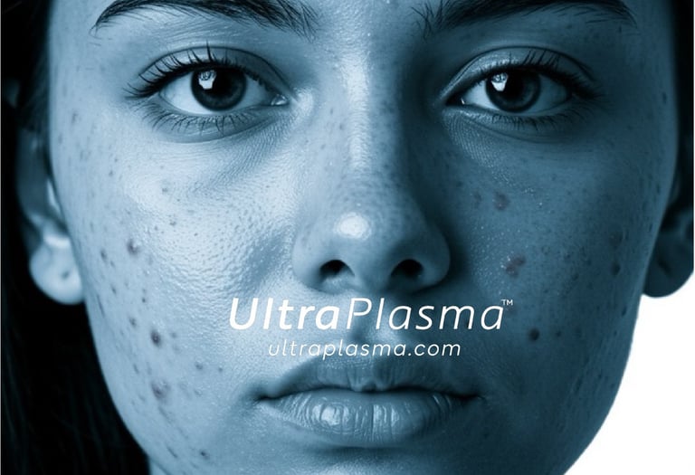 akne_acne_ultra_plasma_ultra_plazma_ultra-plasma_ultra-plazma