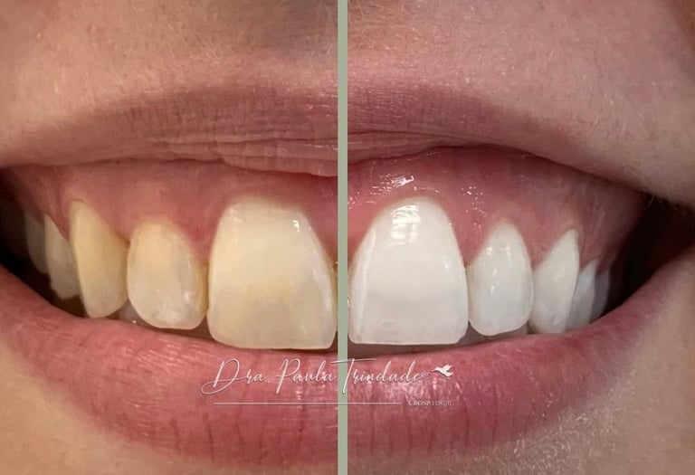 Dra. Paula Trindade - Clareamento dentário - Campinas