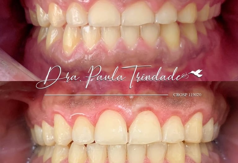 Dra Paula Trindade Cirurgia de Gengivoplastia: tratamento odontológico estético e funcional Campinas