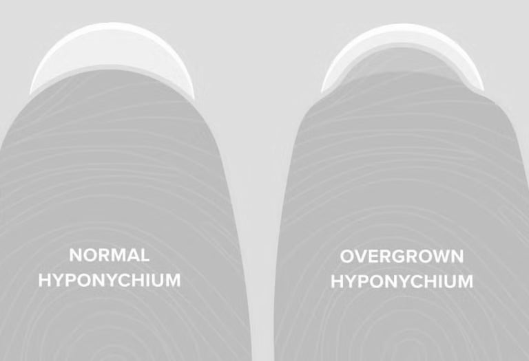 Overgrown hyponychium