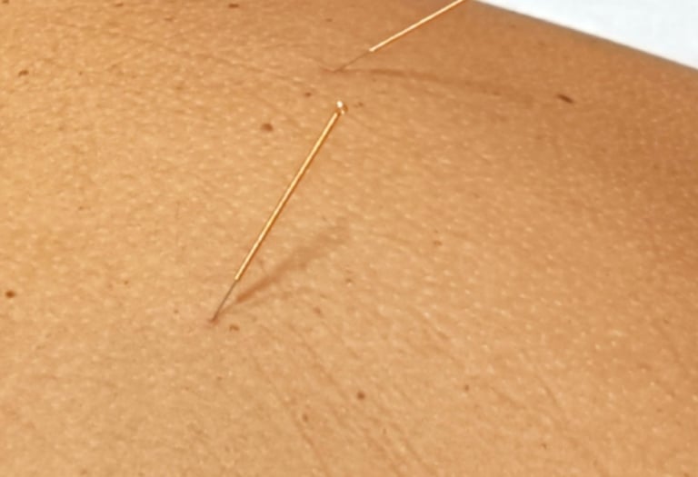 Dry needling treatment with acupuncture needles for muscle pain relief