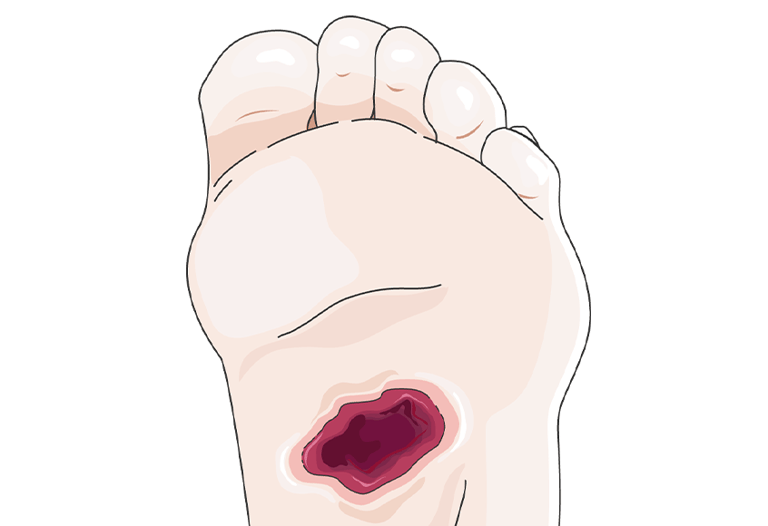 Illustration of a diabetic foot sore