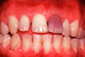 a image showing pink tooth 