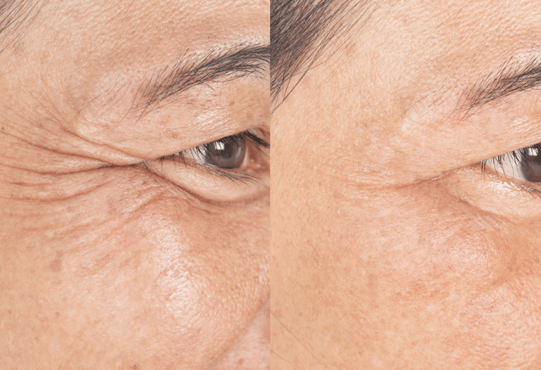 Tratamento com botox para suavizar rugas e linhas de expressão na clínica médica e dentária em Setúb