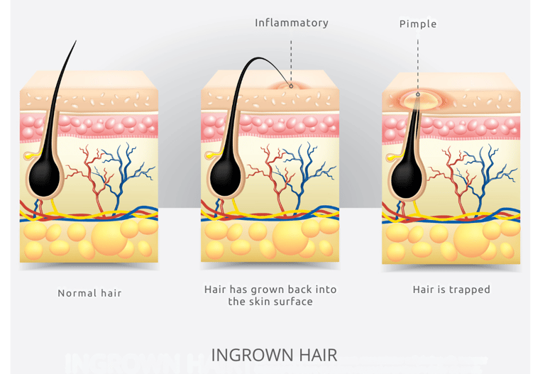 Image of Ingrown Hairs