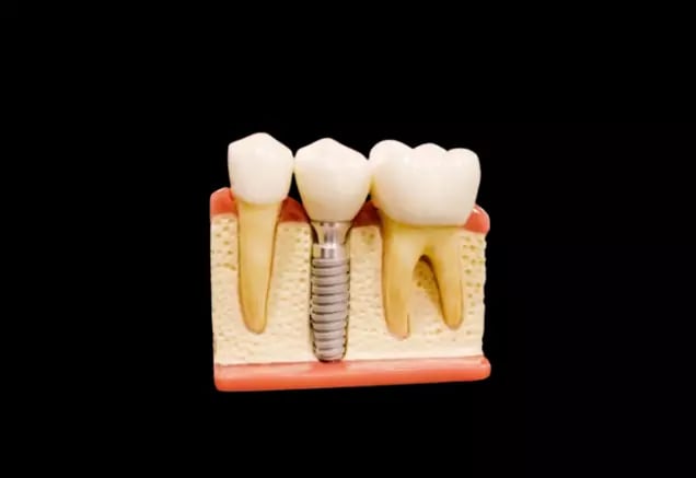 dental implants in Allegany County Cumberland and Frostburg Maryland