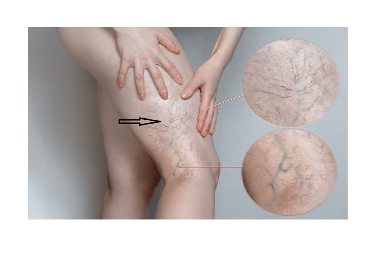 Bluish spider veins on legs and thighs before Sclerotherapy for cosmetic improvement.