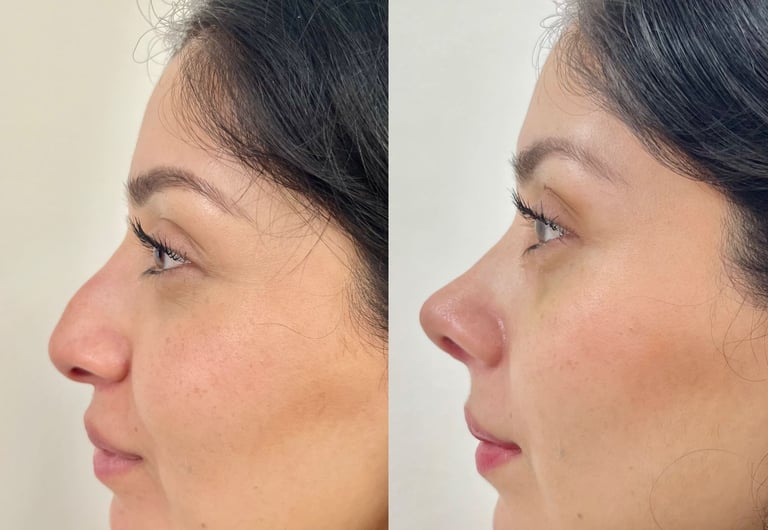 Perfil lateral de una mujer antes y después de una rinoplastia.