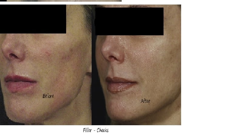 Before & after image filler mid face – improved ogee curve, even skin tone and more radiance.