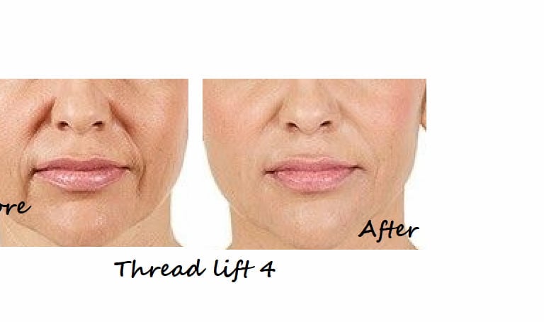 Non-surgical thread lift with fillers and fat reduction, results on a 50-year-old woman.