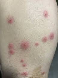 picadas de percevejo de cama