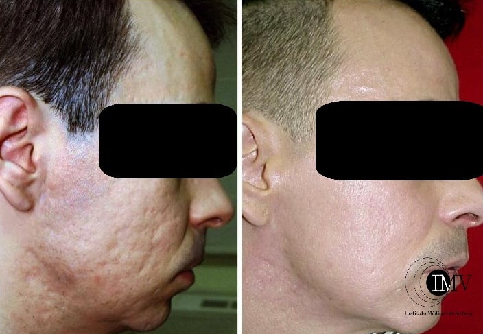 Tratamiento Acné, Laser Piel, Cambrils, Tarragona, Instituto Médico Vilafortuny,