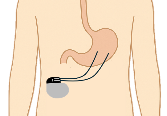 pacemaker gastrique
