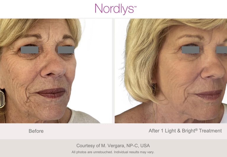 professional skin rejuvenation treatment for brighter and healthier skin in Hamilton clinic