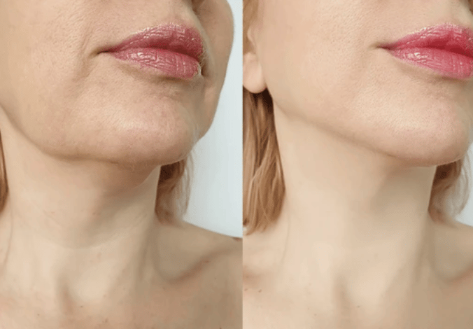 Harmonização do contorno facial com preenchimento de mandíbula na clínica médica e estética em Setúb