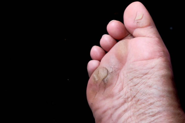 Ayak Kangreni Nedir? Belirtileri, Nedenleri ve Tedavi Seçenekleri