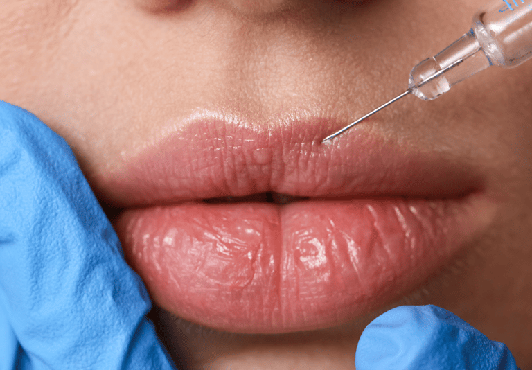 Lábios mais volumosos e hidratados com preenchimento labial na clínica estética em Setúbal.