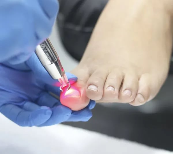 Tratamiento-laser-onicomicosis