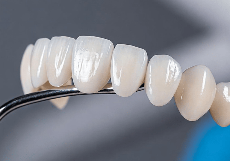 carillas dentales en las palmas de gran canaria