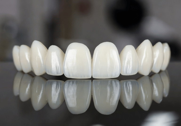 carillas dentales en las palmas de gran canaria