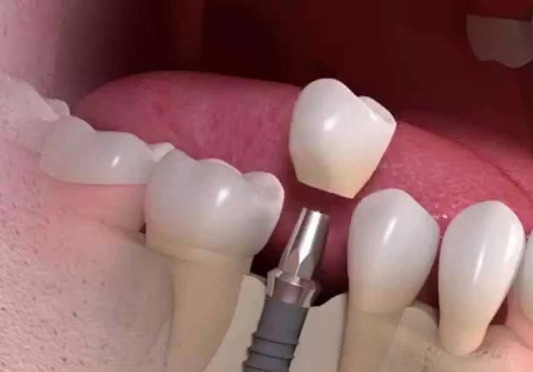 Beautify Your Smile With Dental Implants in Pune