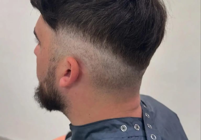 male hair loss clinic Hull