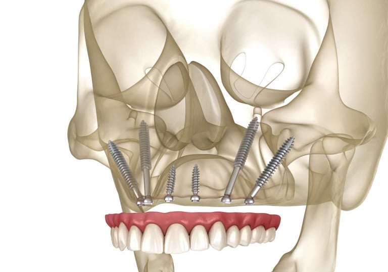implantes cigomaticos