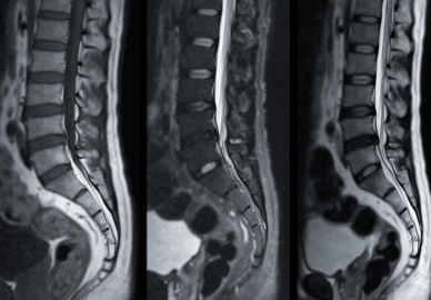 Magnetkamerabilder (MR) av ryggraden som visar olika sekvenser för diagnostik.