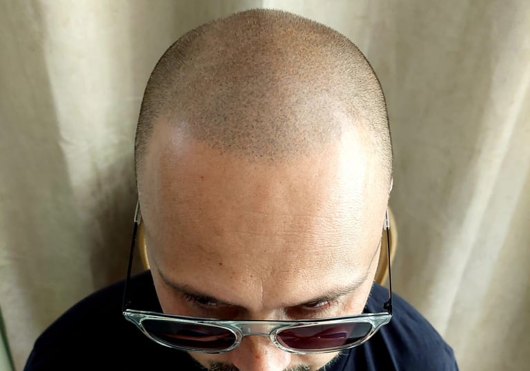 homme atteint de calvitie totale