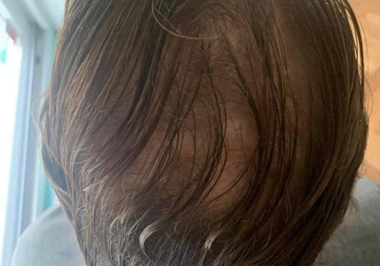 homme qui a une perte de densité capillaire