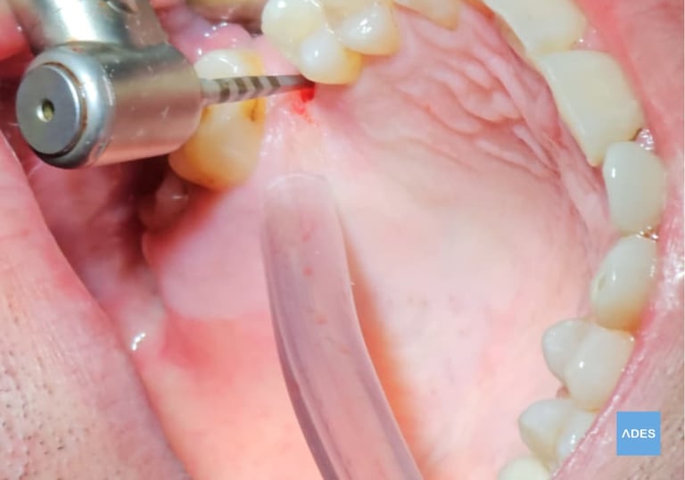 Implantología dental en Badajoz