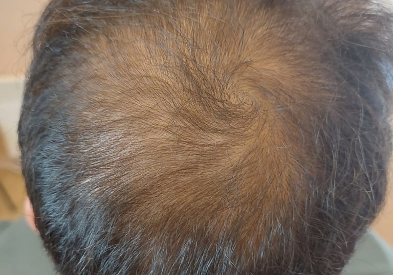 homme avec une calvitie partielle