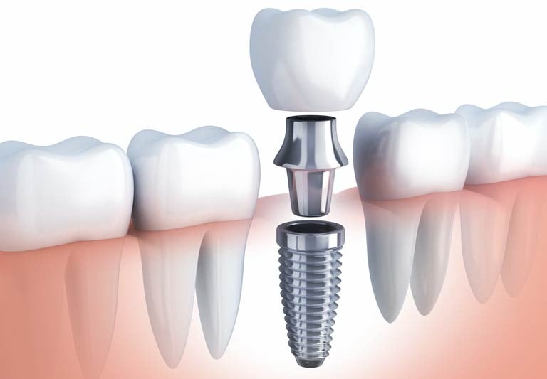best dental implants in baner