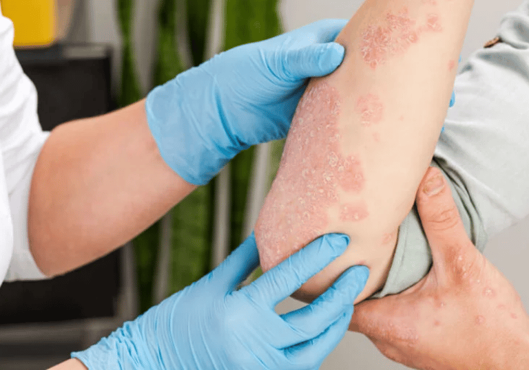 Eczema & Psoriasis Treatment
