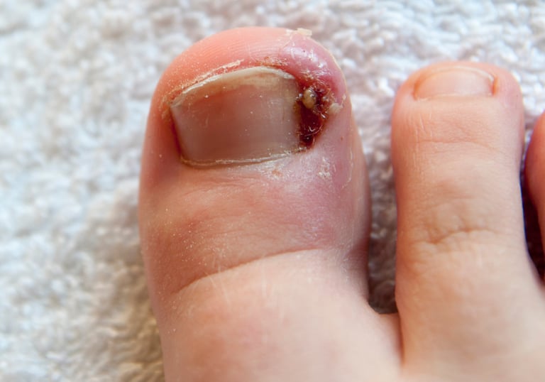 uñas encarnadas