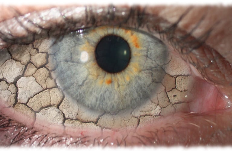 Tratamiento del Síndrome de Ojo Seco en Guayaquil