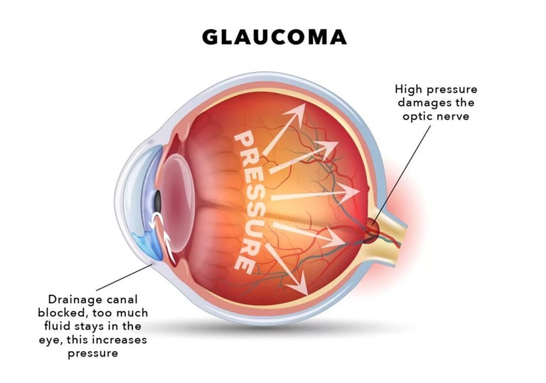 Diagnóstico y Tratamiento de Glaucoma en Guayaquil