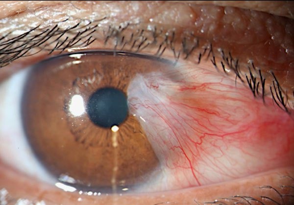 Tratamiento del Pterigión o Carnosidad en el ojo en Guayaquil