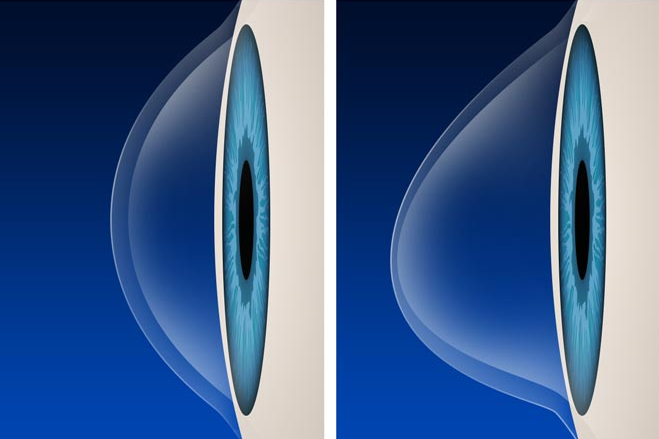 Diagnóstico y Tratamiento del Queratocono en Guayaquil