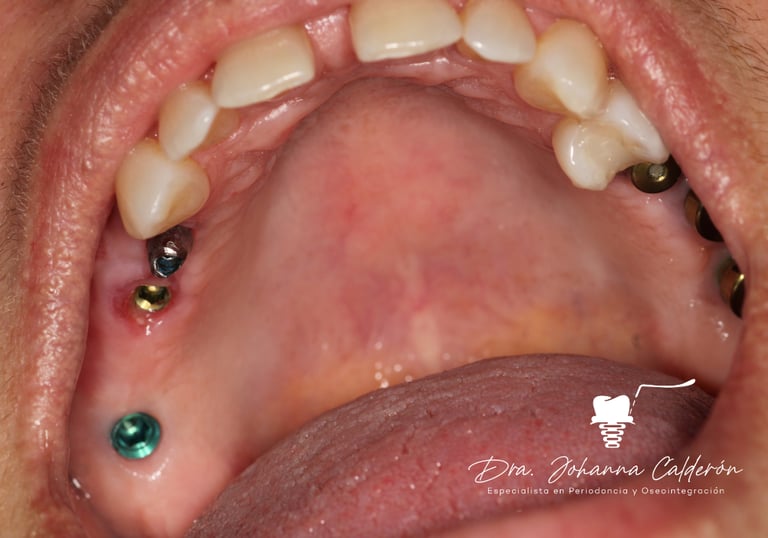 dental implants columbia