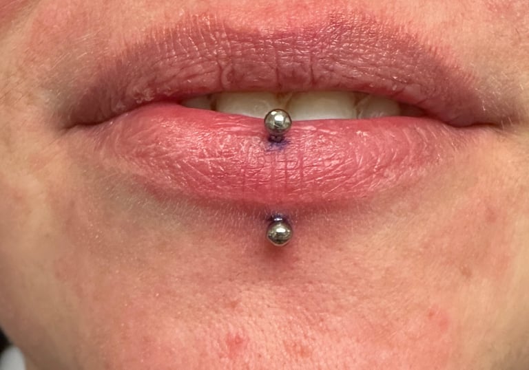 A vertical lip piercings, with a barbell